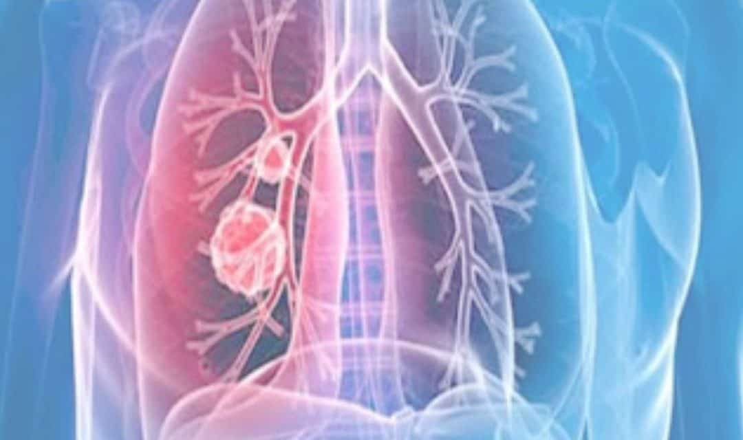 Aumenta vulnerabilidad de personas con Hipertensión Arterial Pulmonar en Venezuela ante escasez de fármacos