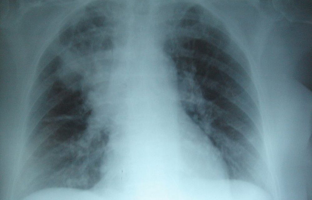 667 pacientes con fibrosis quística en Venezuela no tienen medicinas
