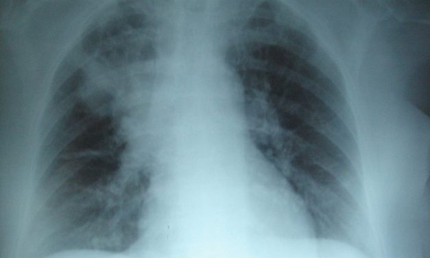 667 pacientes con fibrosis quística en Venezuela no tienen medicinas